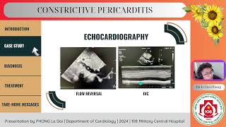 Constrictive pericarditis [upl. by Coral]