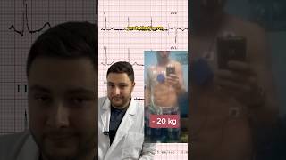 Holter ECG  Explained 🤓 medicalstudent medicaleducation futuredoctor medical cardiology ecg [upl. by Greg]