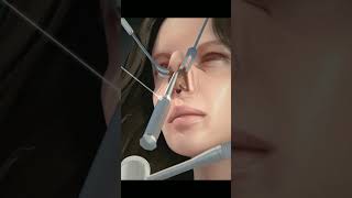 Nose Job Rhinoplasty animation 4k asmr satisfying [upl. by Persas328]