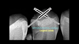 Opportunistic Caries  Minimally Invasive Approach [upl. by Hobbie590]