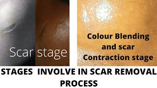 STAGES INVOLVED IN SCAR OR TRIBAL MARK REMOVAL PROCESS [upl. by Moht]