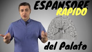 Espansore Rapido del Palato [upl. by Columbine]