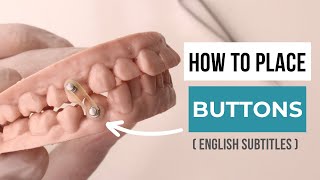 HOW TO PLACE BUTTONS IN ORTHODONTICS [upl. by Erdnaed]