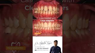 Clear Aligners Invisible Braces Before amp After [upl. by Nyroc]