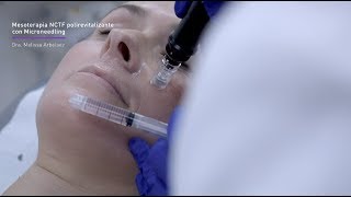 Revitaliza el rostro con Mesoterapia Microneedling [upl. by Ilil]