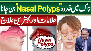 Gadood in Nose OR Nasal Polyps  Symptoms and Treatment of Nasal Polyps  Nose Polyps Ka ilaj [upl. by Ossie]