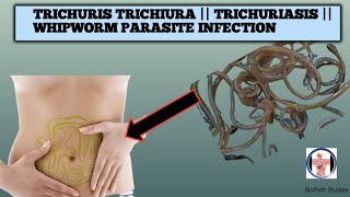 Know about Trichuris Trichiura TrichuriasisWhipworm parasite infection its lifecycle pathogenesis [upl. by Henryk]