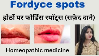 Fordyce spots treatment  होठों पर फोर्डिस स्पॉट्स सफ़ेद दाने  Fordyce spot symptoms amp treatment [upl. by Eleumas]