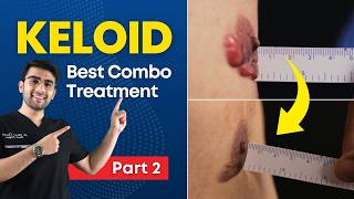 How To Get Rid of Keloid Scar  Part 2  Keloid Scar Removal  Keloid Best treatment  Dr Dhruv Pune [upl. by Nels]