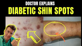 Doctor explains DIABETIC DERMOPATHY AKA DIABETIC SHIN SPOTS – plus causes and prevention [upl. by Errehs]