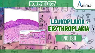 Leukoplakia and Erythroplakia  GIT Morphology  English [upl. by Ihteerp]