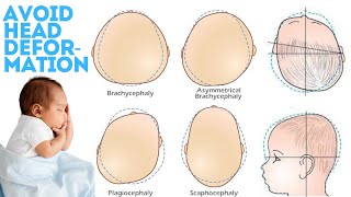 how to prevent flat head syndrome in infants [upl. by Alexander]