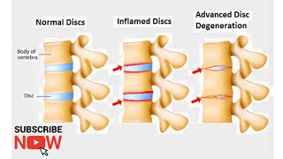 Vratna spondiloza bol u VRATU ispravite se za 5 min Cervical spondylosis NECK pain [upl. by Krik]