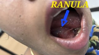 Ranula  Sublingual gland Retention cyst  Salivary gland  marsupialization  Surgical treatment [upl. by Laohcin998]