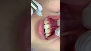 Infiltration anesthesia of the central incisors  Инфильтрационная анестезия центральных резцов [upl. by Nillad424]