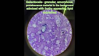 Cytologygalactocelebenign breast disease pathologymedical [upl. by Nihahs]