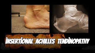 Why Achilles Tendinopathy Happens and How to Fix It [upl. by Hnil221]