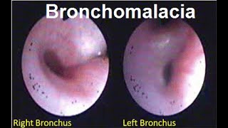 Bronchomalacia Treatment  Symptoms and Causes  Diagnosis  Prevention disease healthcare [upl. by Hepza430]