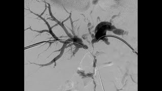 Percutaneous Transhepatic Cholangiography and Drainage PTCD [upl. by Whiteley]