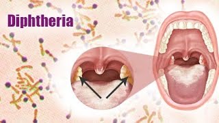 Diphtheria  Introduction of diphtheria  Definition of diphtheria  causes of diphtheria💯✨ [upl. by Ettennig915]