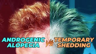 How To Test If Your Hair Loss Is Androgenic Alopecia Or Temporary Shedding [upl. by Jobina]