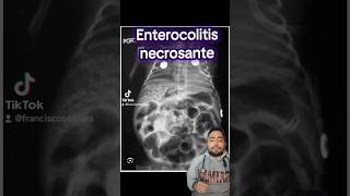 Enterocolitis necrosante ⚠️🧑‍⚕️ pediatrics intestino medico sabiasque medstudent med [upl. by Sivla681]