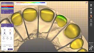 design reduced crown for metalo ceramic design exocad 32 elefsina 38 [upl. by Jack]