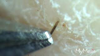 Satisfying Ingrown Hair Plucking Compilation 2 [upl. by Aihsital]