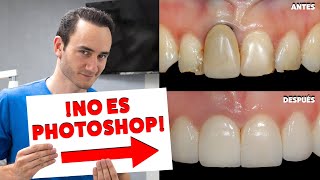 ¡CORREGIMOS UNA ENCÍA RETRAIDA SIN CIRUGIA  Una Alternativa a los injertos  NO ES PHOTOSHOP [upl. by Brooking147]