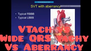 Wide complex tachycardia vs Vtach DD amp management WCT widecomplextachycardia VT [upl. by Sloane116]