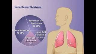 The Pathophysiology of Nonsmall Cell Lung Cancer [upl. by Lytle]