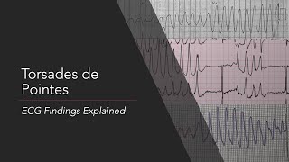 Torsades de Pointes ECG Findings Explained [upl. by Inessa]