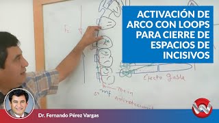 Activación de arco con loops para cierre de espacios de incisivos [upl. by Miarfe]