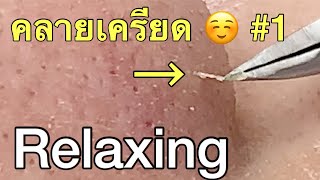 กดสิว blackheads filaments on nose remove with tweezers [upl. by Uund]