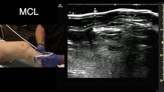 Ultrasound of the Knee Collateral Ligaments [upl. by Ettenaej]