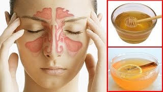 How To Get Rid of a Sinus Headache Fast  Sinus Pressure Relief [upl. by Dloreg]