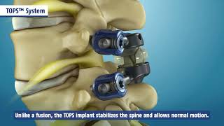 TOPS System  Cures Lumbar Spinal Stenosis Spondylolisthesis [upl. by Kaia41]