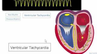 ECG Rhythm Review Ventricular Tachycardia Torsades de points Asystole [upl. by Aseneg]