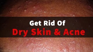 Acne Treatment On Face For Dry Skin  Home Remedies [upl. by Mitzl76]