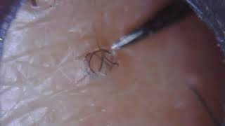 Long ingrown hair removal 23 [upl. by Wilen348]