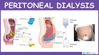 Peritoneal Dialysis Introduction Physiology Technique Modes and Complications [upl. by Timms]