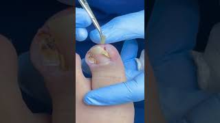 Uña encarnada en paciente de 15 años satisfying ingrowntoenail [upl. by Natek203]