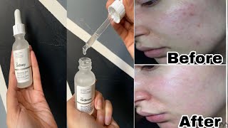 TESTING THE ORDINARY NIACINAMIDE ZINC FOR MY ACNE SCARRING FOR 1 MONTH Original vs Fake [upl. by Lehcem830]