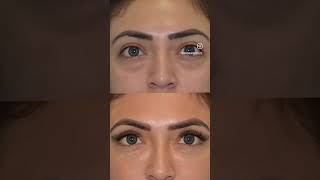 Before amp After Under Eye Filler [upl. by Amlev]