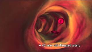 What is atherosclerosis [upl. by Shepperd]