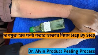 Hand Peeling  Chemical Peel  হাত এতো লাল কিসের লক্ষণ  পিলিং কি ক্ষতিকর  সাইড ইফেক্ট  Whitening [upl. by Nerua]