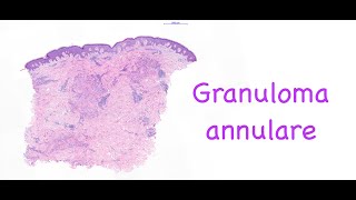 Granuloma annulare [upl. by Naes]