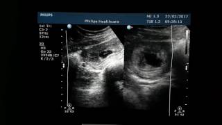 Subchorionic Hemorrhage Ultrasound [upl. by Aerdnahc310]