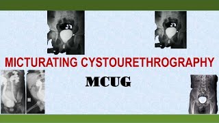 Micturating Cystourethrography MCUG [upl. by Ivie]