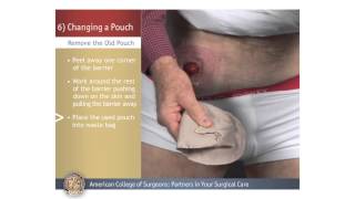 ColostomyIleostomy Changing a Pouch [upl. by Airenahs]